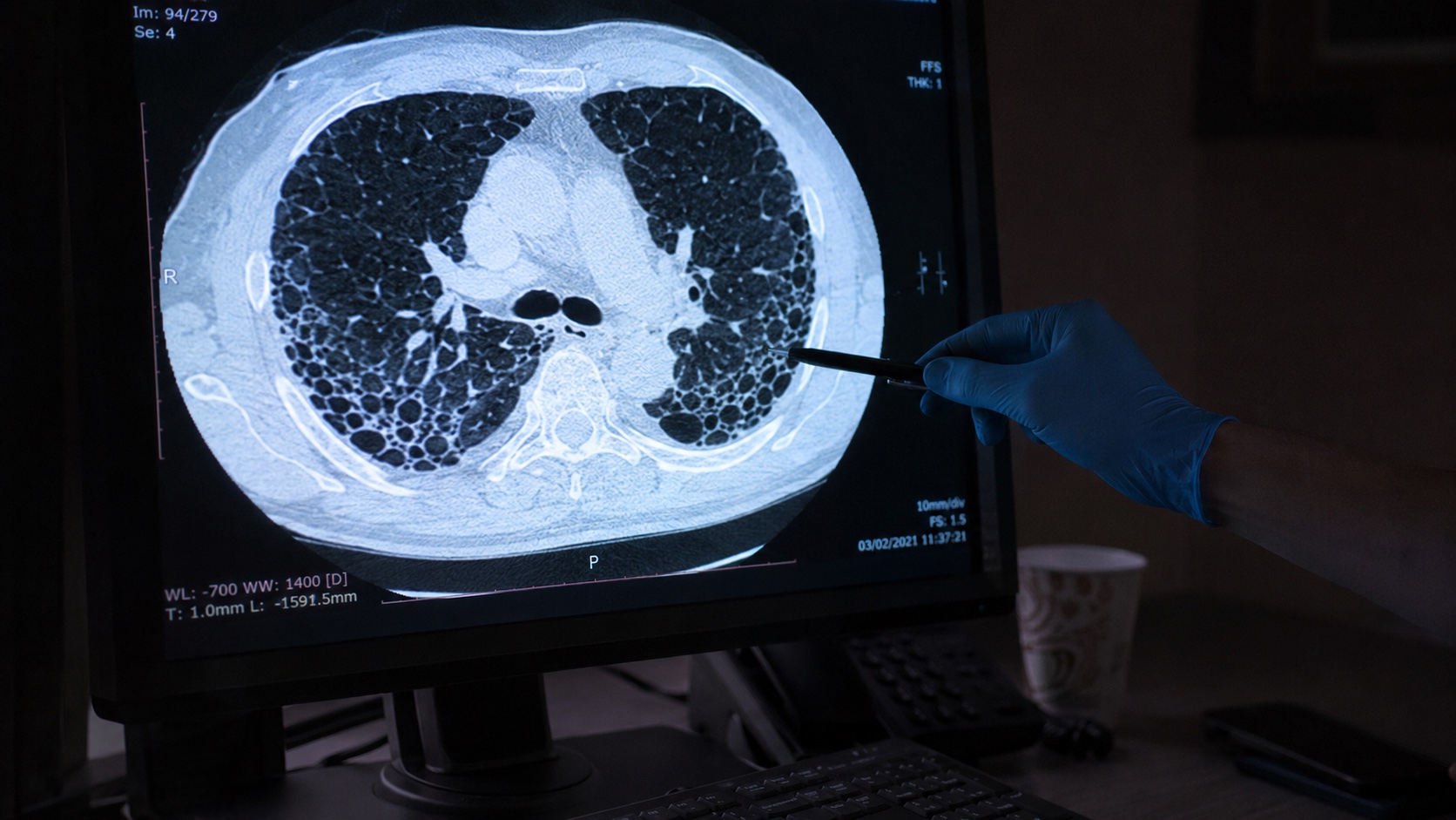 HRCT chest showing usual interstitial pneumonia pattern of idiopathic pulmonary fibrosis - honeycombing and traction bronchiectasis in the lower peripheral lung zones